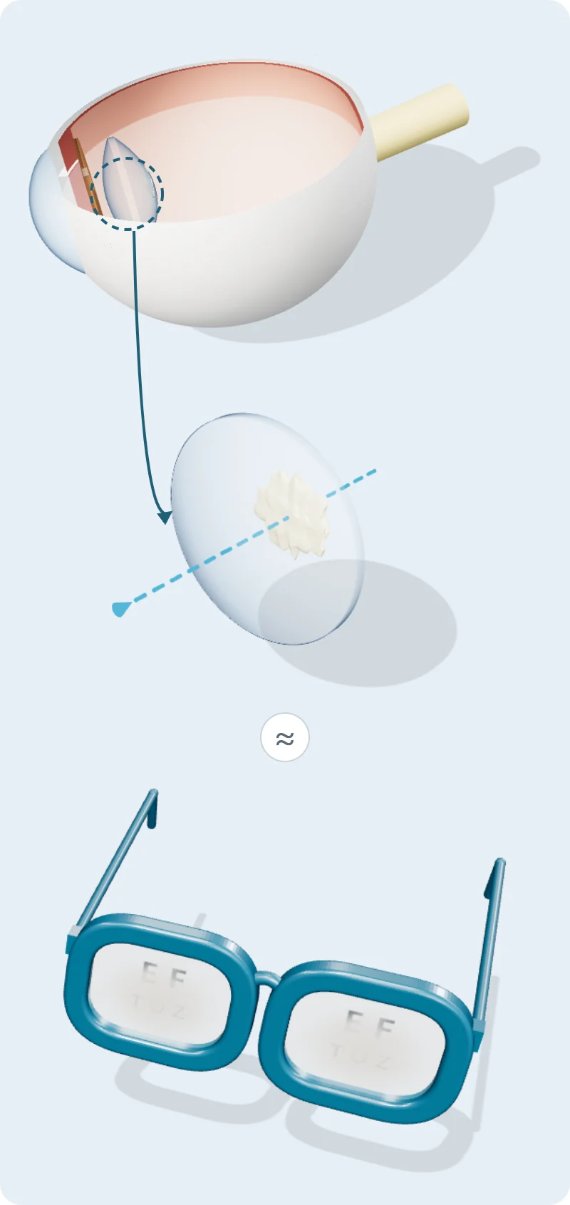 Ilustración 3D de una catarata subcapsular posterior: placa irregular en la cara posterior del cristalino, comparada con una mancha en el centro de una gafa