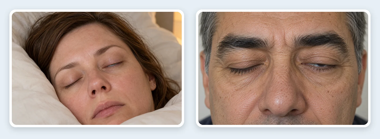 Lagoftalmos: un ojo entreabierto durante el sueño y un ojo que no cierra del todo al intentar cerrar los ojos