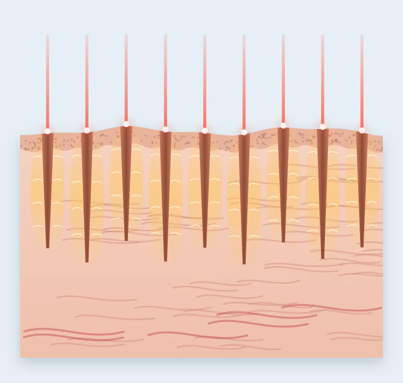Esquema del láser CO2 fraccionado actuando en microcolumnas sobre la piel