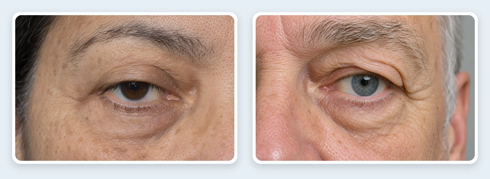 Párpado caído (ptosis) y exceso de piel en el párpado superior (dermatocalasia)